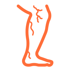 Stentgraftbehandlung